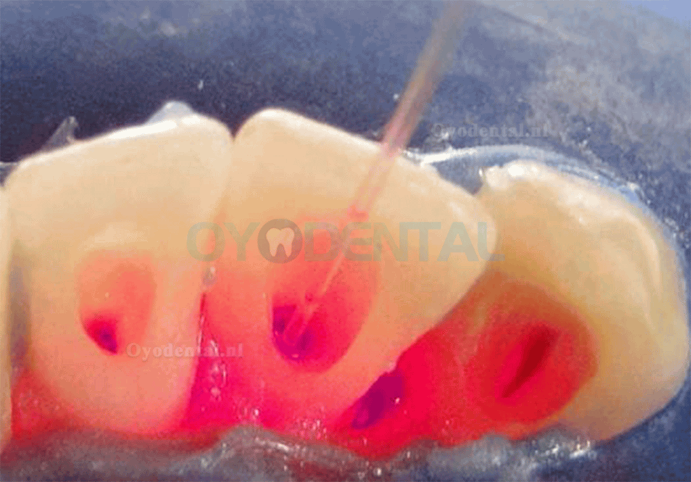 Diode Laser Tandheelkunde Draadloze Pen Parodontale Zacht weefsel Endodontische Chirurgische Wortel